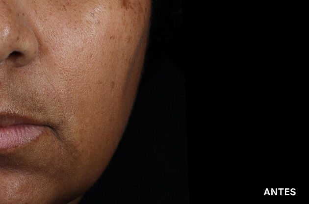 Antes e depois do uso do HA Intensifier Multi-Glycan de SkinCeuticals na regiao da boca.