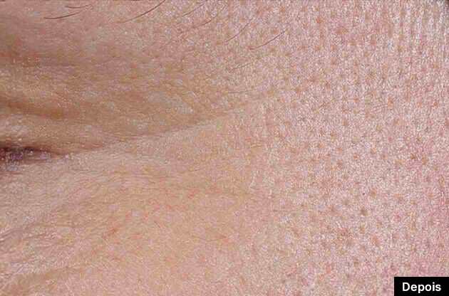 P TIOX antes e depois do tratamento antirrugas com Serum anti-idade de SkinCeuticals