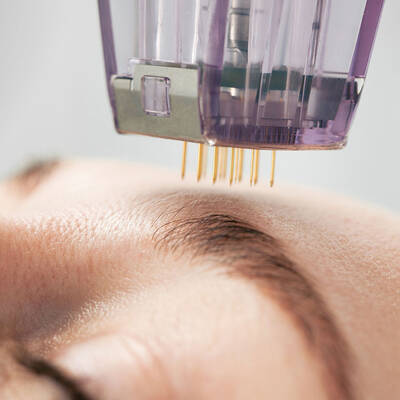 IPL Laser