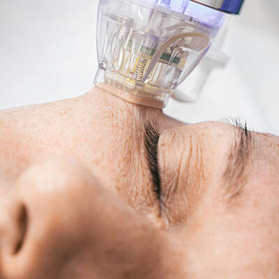 IPL Laser