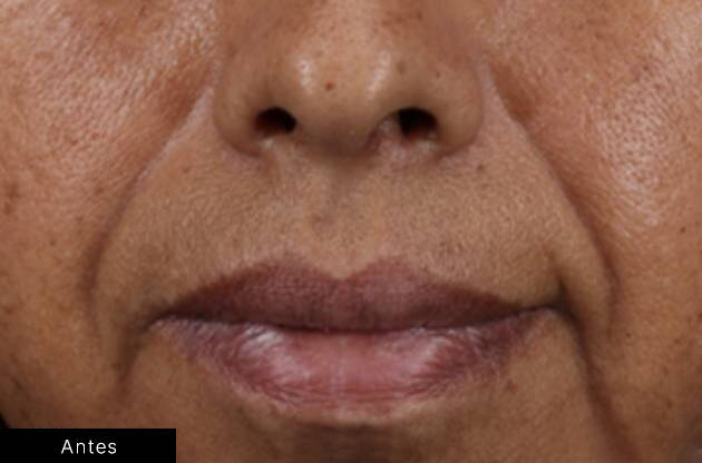 Antes e depois do uso do HA Intensifier Multi-Glycan de SkinCeuticals na regiao da boca.