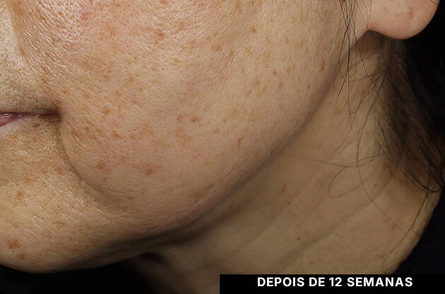 Efeitos do serum de preenchimento da pele de SkinCeuticals nas marcas de expressao da testa.