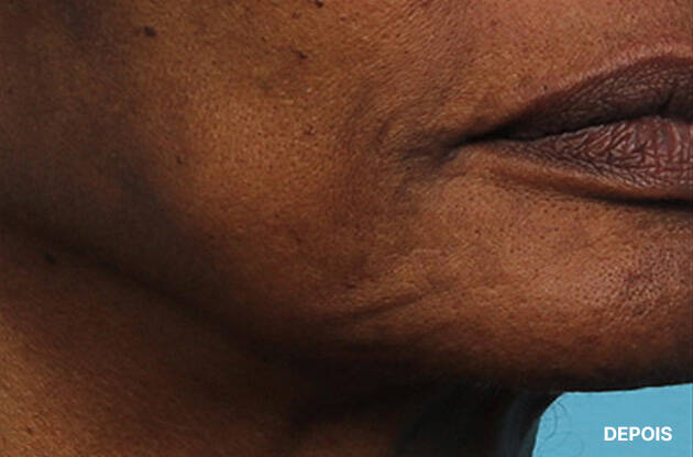 Antes e depois do uso do A.G.E Interrupter Ultra Serum de SkinCeuticals na regiao da bochecha.
