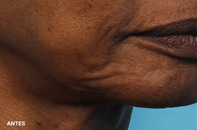 Antes e depois do uso do A.G.E Interrupter Ultra Serum de SkinCeuticals na regiao da bochecha