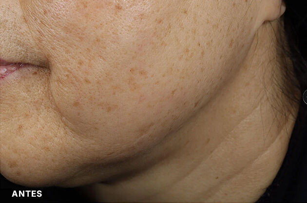 Efeitos do serum de preenchimento da pele de SkinCeuticals nas marcas de expressao da testa.