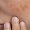 Hyaluronic Acid