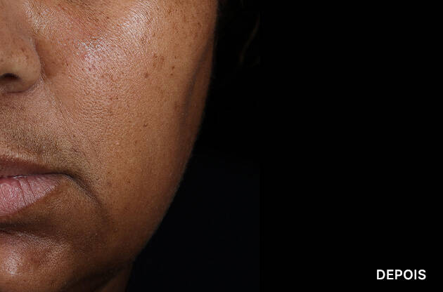 Antes e depois do uso do HA Intensifier Multi-Glycan de SkinCeuticals na regiao da boca.