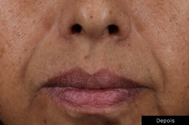 Antes e depois do uso do HA Intensifier Multi-Glycan de SkinCeuticals na regiao da boca.