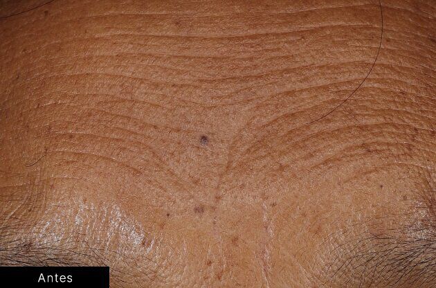 Efeitos do serum de preenchimento da pele de SkinCeuticals nas marcas de expressao da testa.