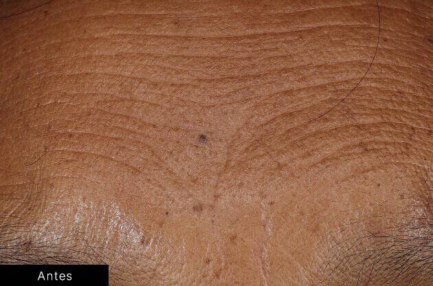 Efeitos do serum de preenchimento da pele de SkinCeuticals nas marcas de expressao da testa.