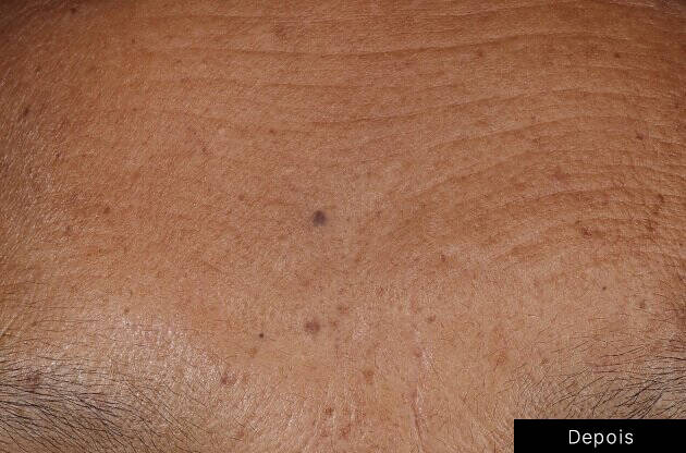 Efeitos do serum de preenchimento da pele de SkinCeuticals nas marcas de expressao da testa.