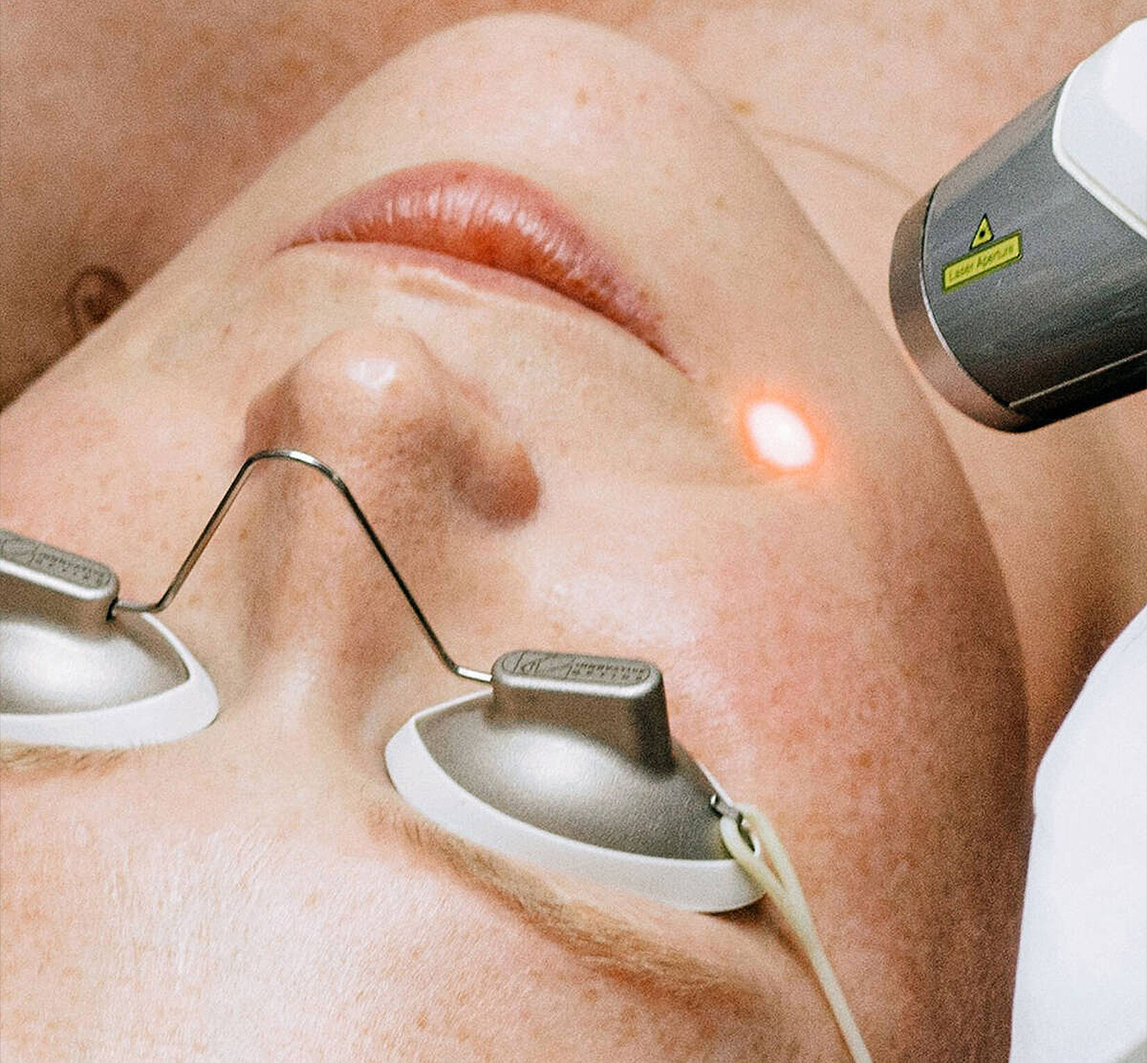Produtos de skincare indicados para quem realizou procedimentos a laser no rosto. 