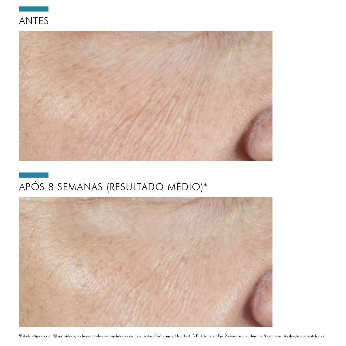 Creme para olheiras, rugas e flacidez – A.G.E. Advanced Eye